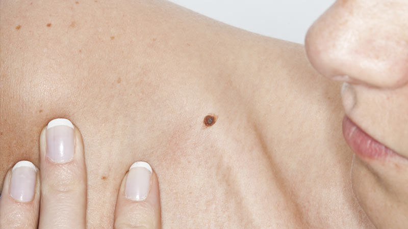 Grande plano de mulher a observar um sinal na pele